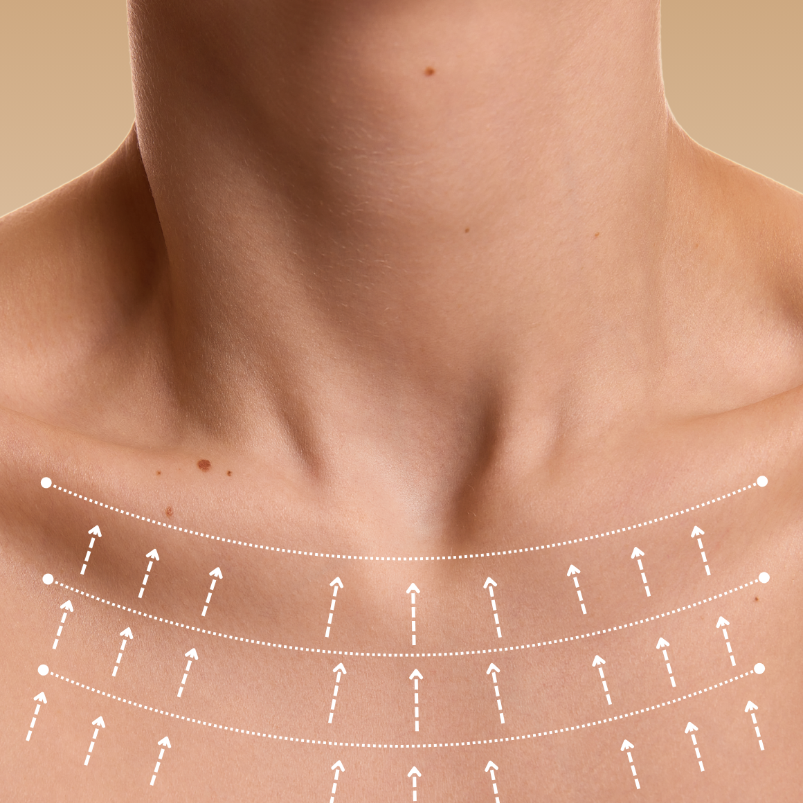 Hautstraffung - Behandlungsbereiche Dekollete