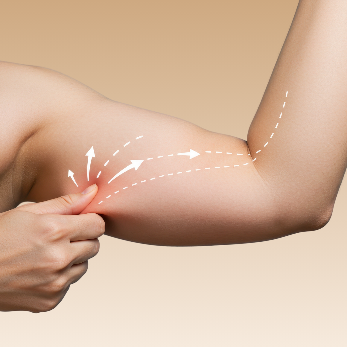 Hautstraffung - Behandlungsbereiche Oberarme